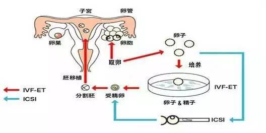 金华试管婴儿